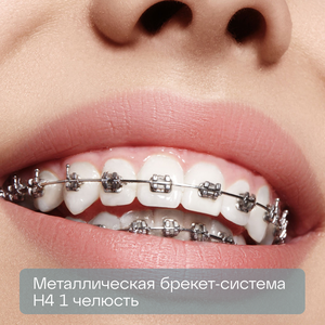 Металлическая брекет-система Н4 1 челюсть