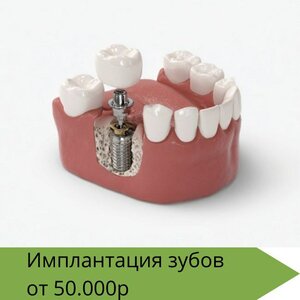 Имплантация зубов