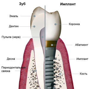 Имплантация зубов 