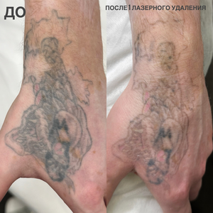 Лазерное удаление тату от