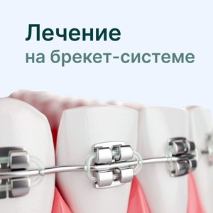 Лечение на брекет-системе.