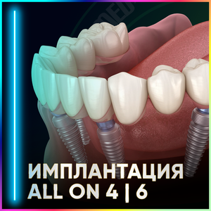 Имплантация All-on-4 | All-on-6