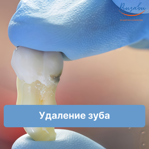 Удаление жевательного зуба