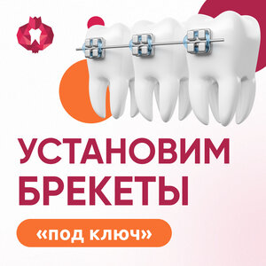 Брекет-система (внутренние брекеты 2D на одну челюсть)