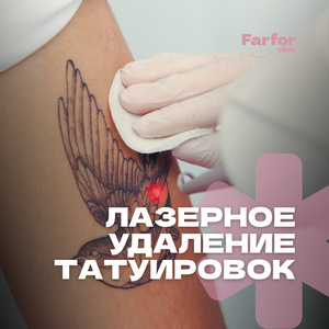 Лазерное удаление татуировок/татуажа