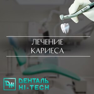 Лечение кариеса от