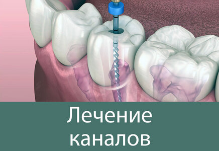 Лечение зубного канала