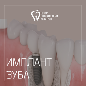 Имплантация зуба от