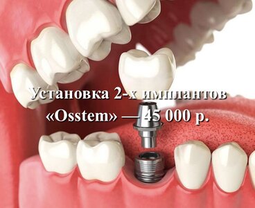 2 импланта за 45000 ₽