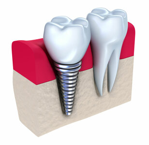 Имплантат Dentium с установкой.