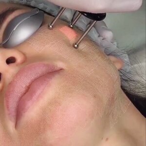 Лазерная шлифовка (Dermablate)