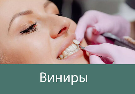 Виниры для зубов