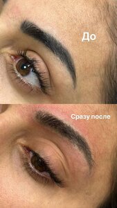 Удаление татуажа