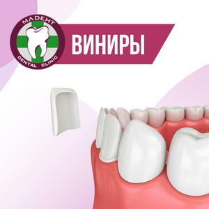Виниры от