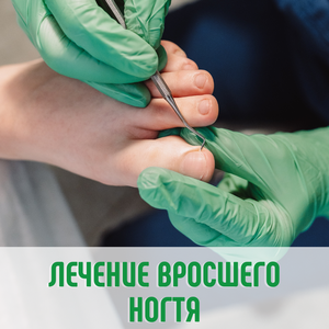 Лечение вросшего ногтя