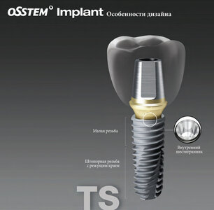 Галерея улыбок. Имплантация Osstem (Ю. Корея )14 500р. 