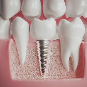 Акция! Установка импланта Dentium - 35 000₽