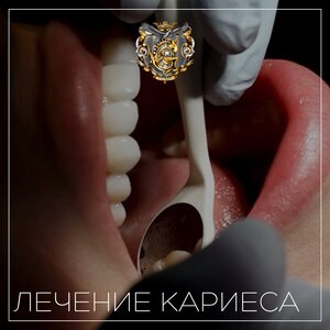 Лечение кариеса от