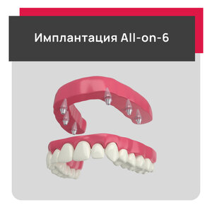 Имплантация All-on-6