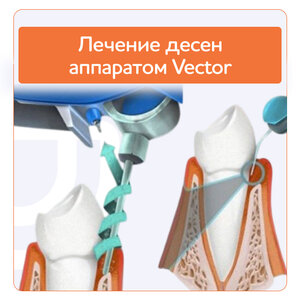 Лечение десен аппаратом Vector