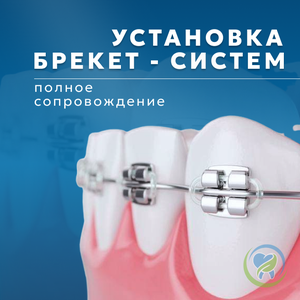 Брекет-системы
