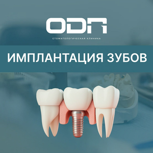 Имплантация зубов от