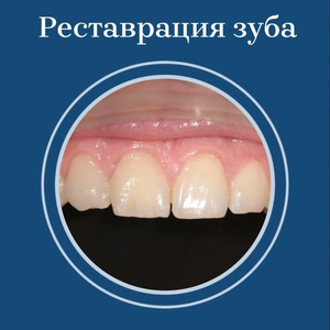 Художественная реставрация зуба