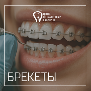 Брекеты от