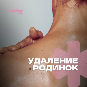 Удаление родинок и новообразований