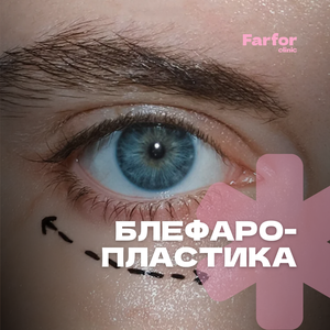 Блефаропластика