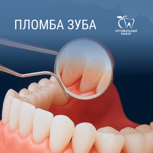 Пломба зуба от 