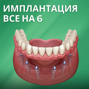 Имплантация "Все на 6" от 