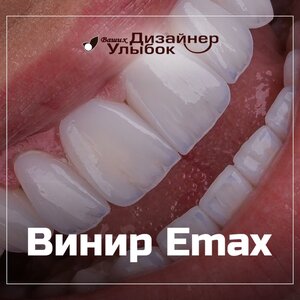 Винир Emax от