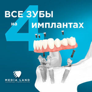 Имплантация «Все на четырёх»