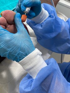 Обработка стопы с гиперкератозом