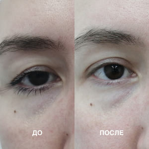 Лазерная СО2 блефаропластика 