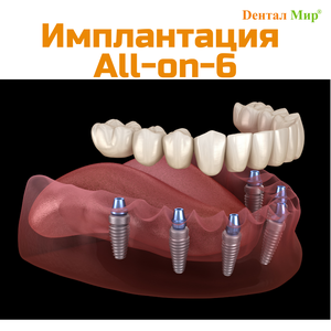 Имплантация All-on-6