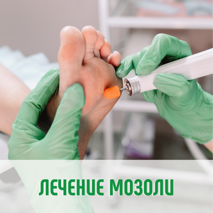 Лечение мозоли