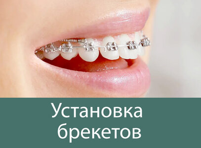 Поставить брекеты