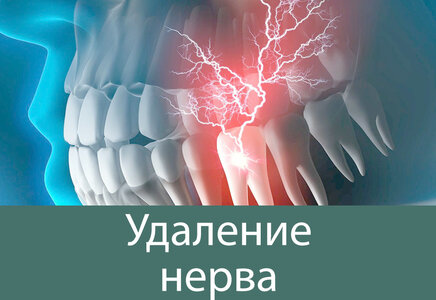 Удаление нерва зуба