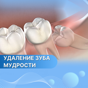 Удаление зуба мудрости 