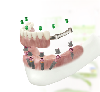 Имплантация всех зубов ReSmile