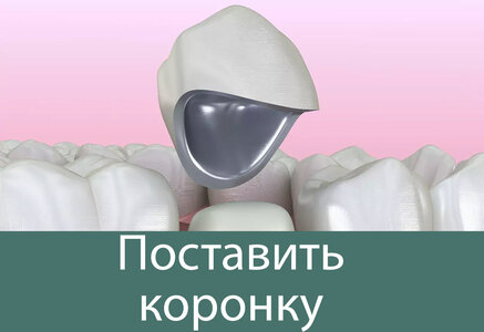 Зубные коронки