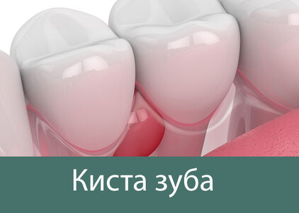 Удаление кисты