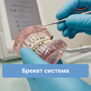 Брекет-система металлическая лигатурная