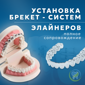 Брекет-системы и элайнеры