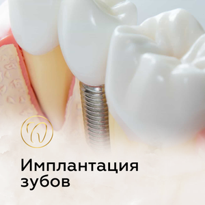 Имплантация зубов в Анапе