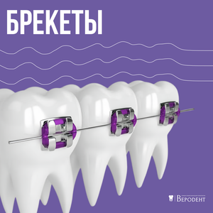 Брекеты