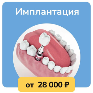 Имплантация зубов