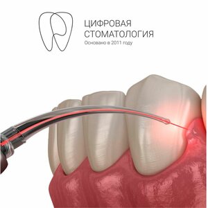 Лазерная коррекция десны